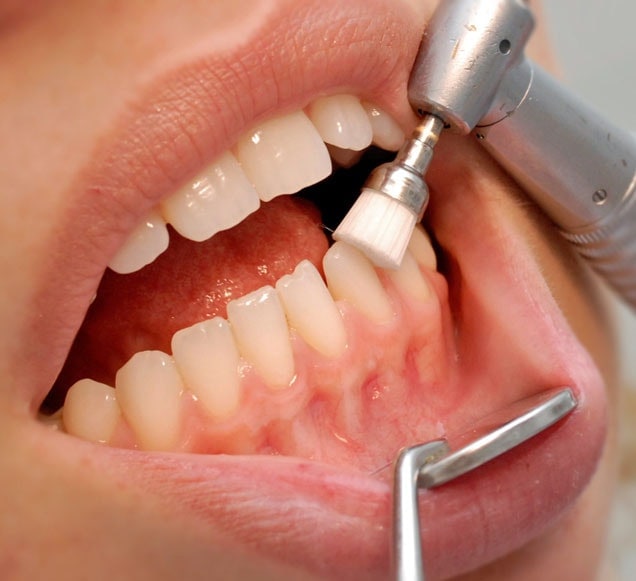 Periodoncia